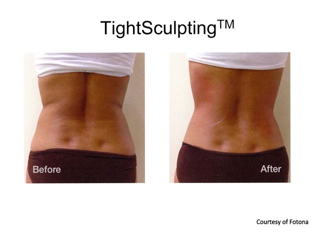 Non-Surgical Fat Reduction