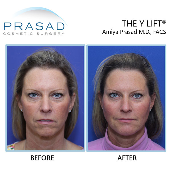 Structural Volumizing by Dr. Amiya Prasad