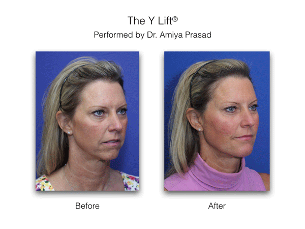 Addressing under eye hollowing by treating volume loss in the cheeks before and after results