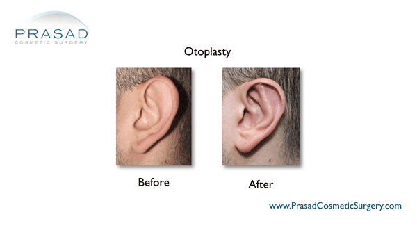 Otoplasty before and after performed by Dr Amiya Prasad left ear