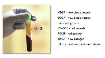 platelet rich plasma therapy