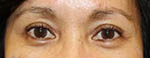 patient after pelleve treatment