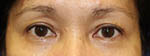 before pelleve treatment