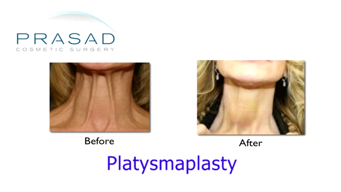Platysmaplasty corrected still
