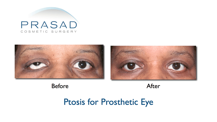 Ptosis Surgery Droopy Eyelid New York Specialist 