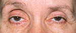 before ptosis surgery
