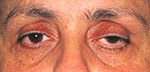 patient before ptosis surgery