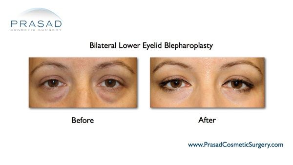 Eye bag surgery | Lower eyelid surgery | Puffy eyes - NY