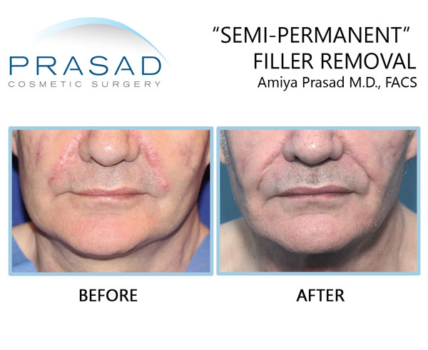 semi-permanent filler removal after complications