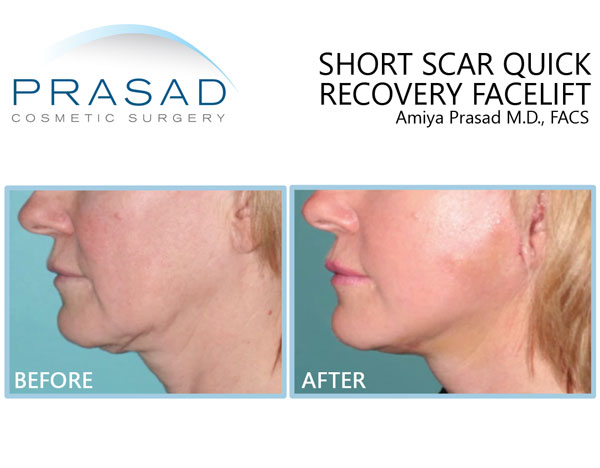 Before and 1 week after short scar quick recovery facelift