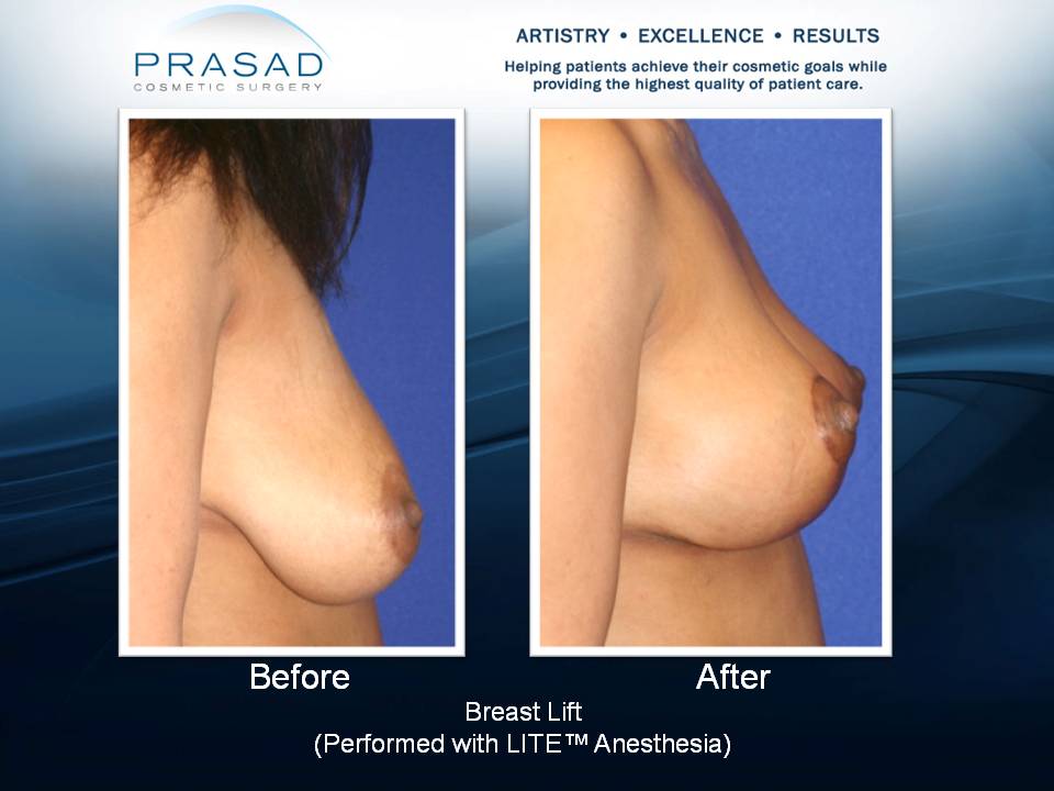 Breast lift surgery