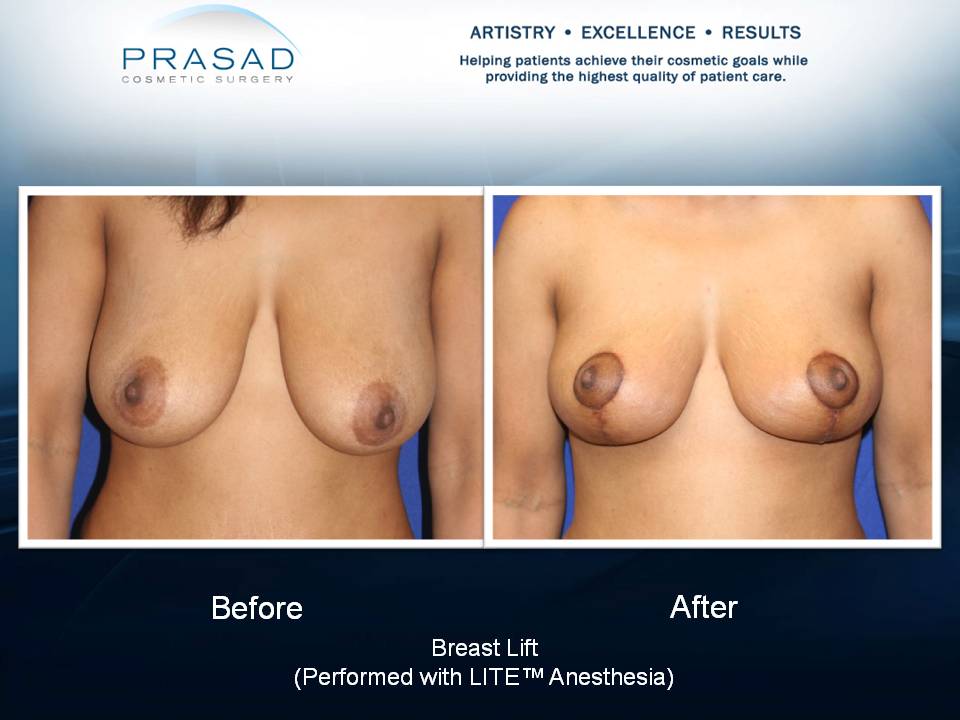 Breast lift surgery