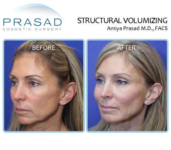 Structural Volumizing before and after