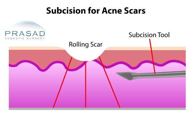 subcision for acne scars