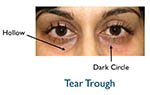 tear trough