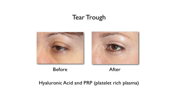 tear trough filler before and after results
