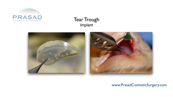 Dr. Amiya Prasad performs tear trough implant surgery using the transconjunctival method