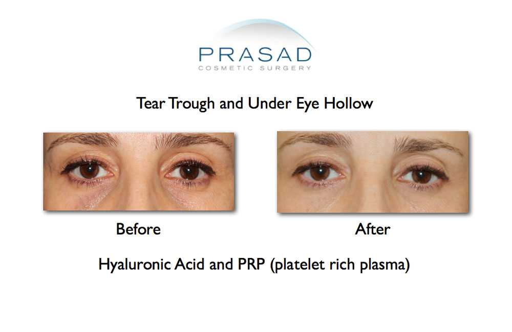 Before and after tear trough and under eye hollow results on female patient