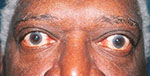 Thyroid Eye Disease African-American Male Elderly