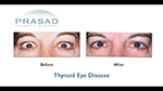 Thyroid Eye Disease