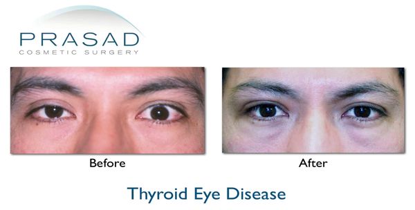 Thyroid Eye Disease- Graves Disease | Dr Prasad NY