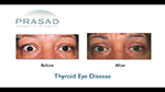 Thyroid Eye Disease