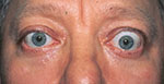 patient with thyroid eye disease