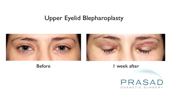 Eyelid Surgery | Upper Eyelid Surgery Procedure and Recovery - NY