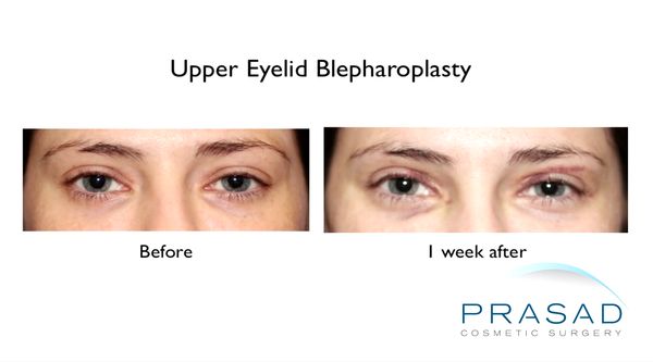 Upper Eyelid Surgery and Recovery | Eyelid Surgery in New York