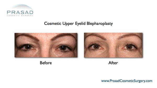 Upper Eyelid Surgery and Recovery | Eyelid Surgery in New York