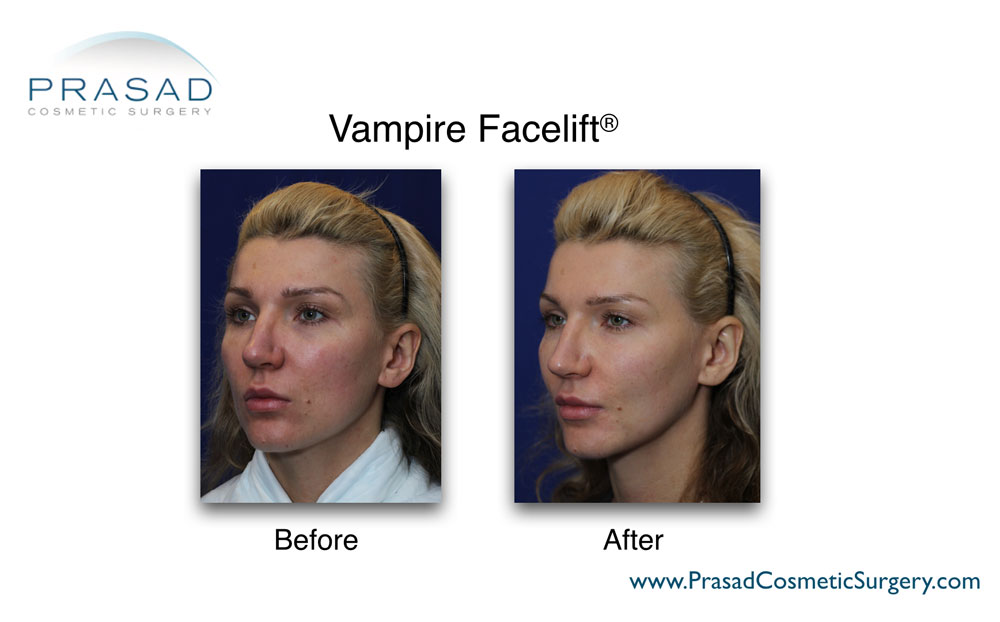 Female patient before and after vampire facelift