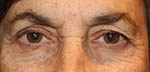 Wrinkles under eyes