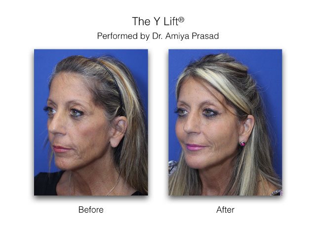 before and after liquid facelift - female patient three-quarter view