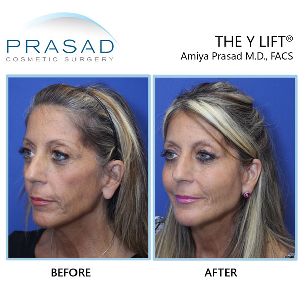 Patient look younger after cosmetic filler treatment