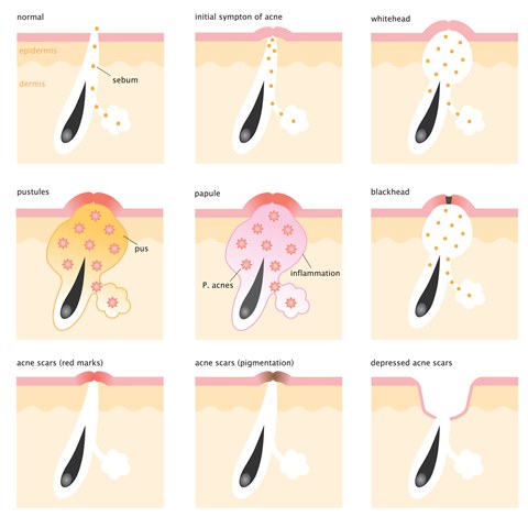 acne scars causes