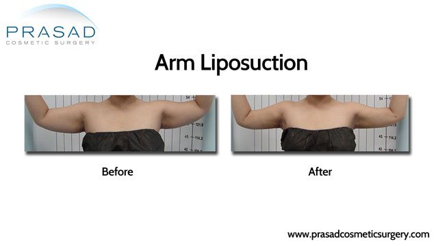 Cool Lipo address fat volume
