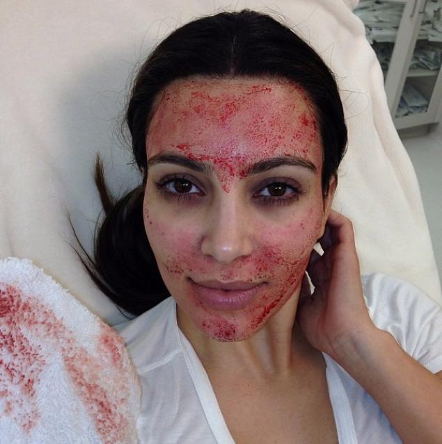 kim kardashian 'vampire facial'