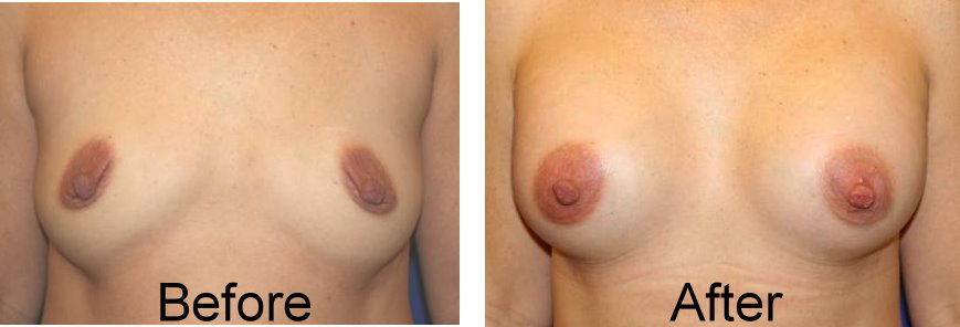 underarm breast augmentation before and after