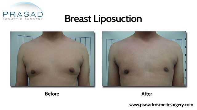 Male breast reduction