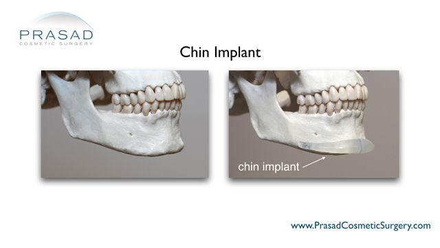 silicone chin implant anatomical placement