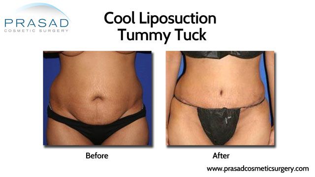 Cool Lipo Tummy Tuck