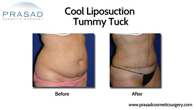 Cool Lipo Tummy Tuck after childbirth
