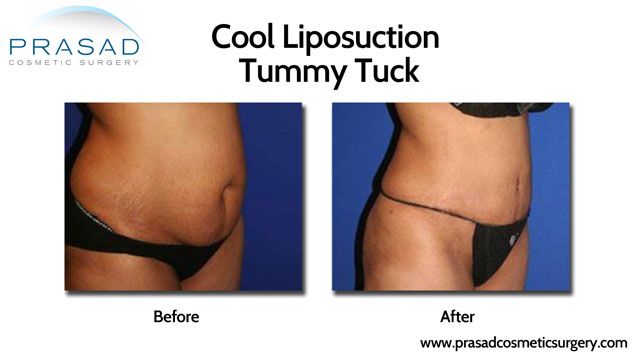 Cool Lipo tummy tuck