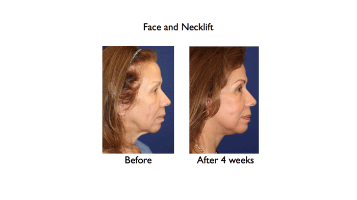 deep plane face and necklift before and after 4 weeks