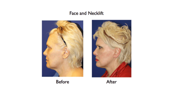 Facelift Surgery | Rhytidectomy - Dr. Amiya Prasad New York