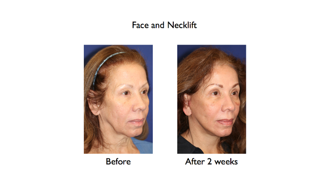 deep plane facelift and necklift before and after 2 weeks