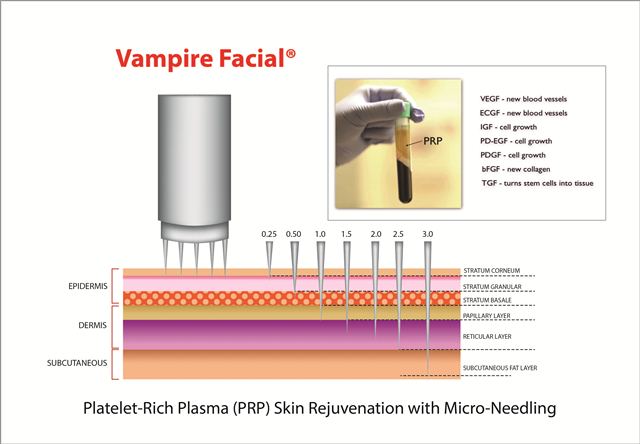 Vampire Facial | Facial Rejuvenation Treatment - NY