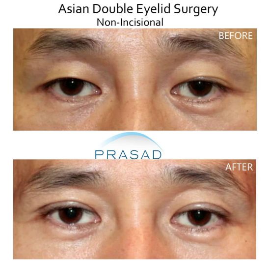 Asian double eyelid surgery before and after results on male patient