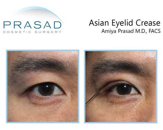Asian eyelid crease demonstration at Prasad Cosmetic Surgery