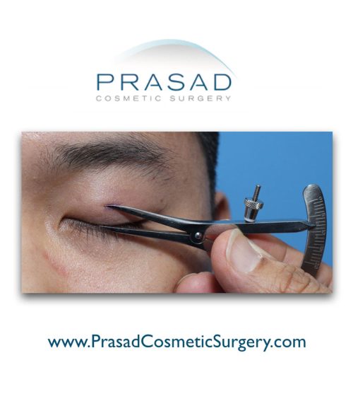 Asian-eyelid-prep-1-1